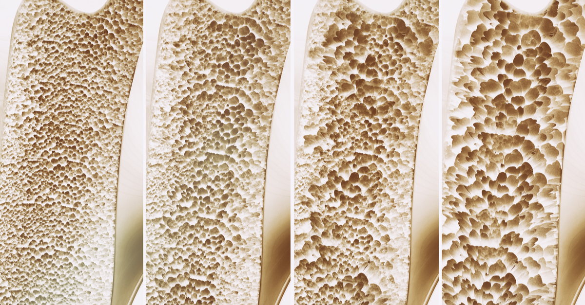 osteoporosis